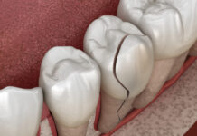 Are Cracked & Damaged Teeth Worth Saving? Are Cracked and Damaged Teeth Worth Saving
