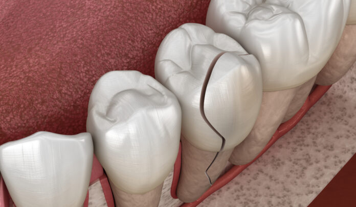 Are Cracked and Damaged Teeth Worth Saving