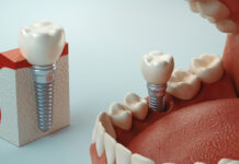 Potential Complications After Dental Implant Surgery Dental Implants Replacement