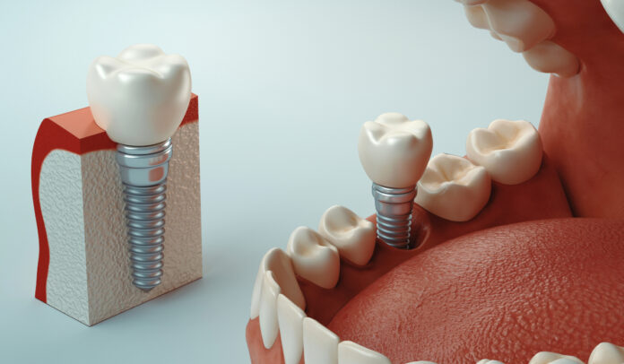 Dental Implants Replacement